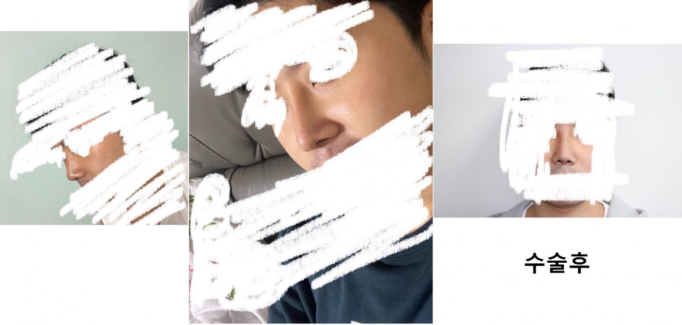 복코 짧은코 작은코 처진 남자코ㅎㅎ 수술후기입니다