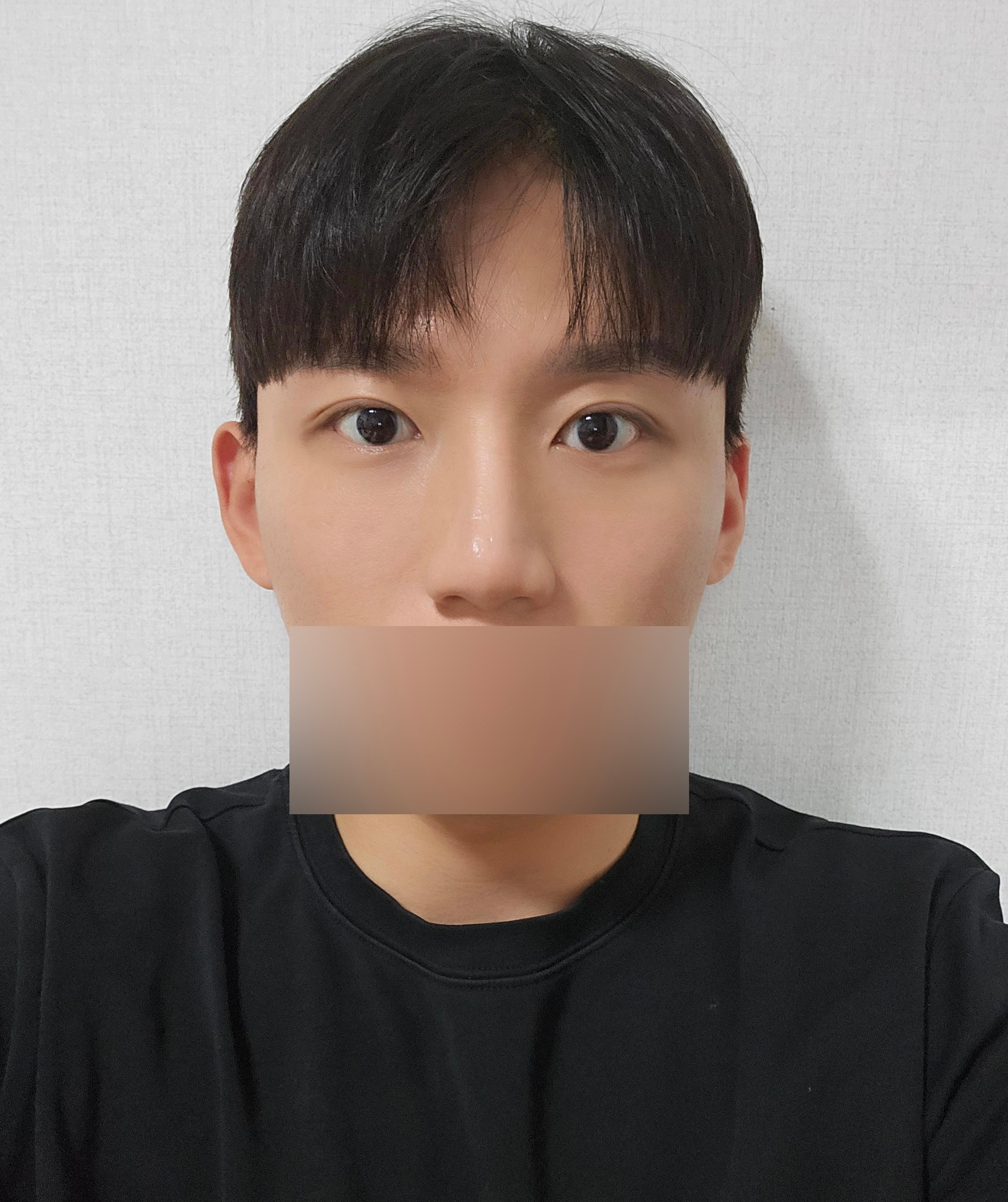 수술후기이미지
