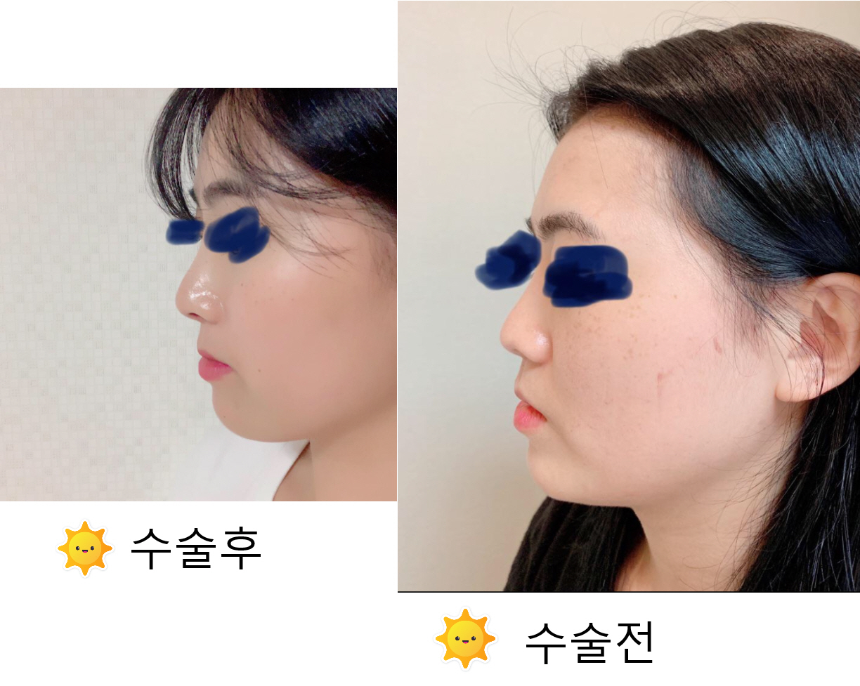 수술후기이미지