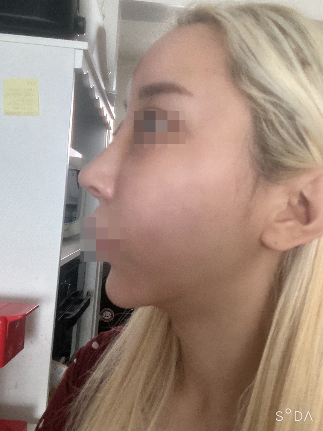 수술후기이미지