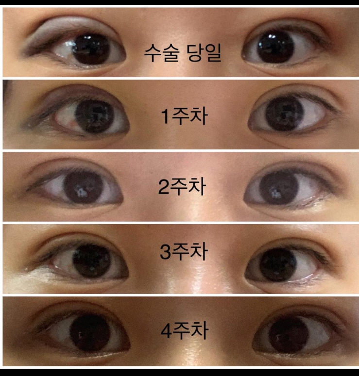 수술후기이미지