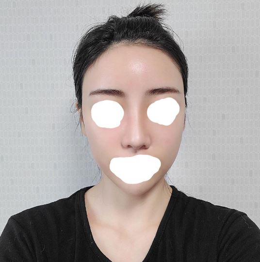 수술후기이미지