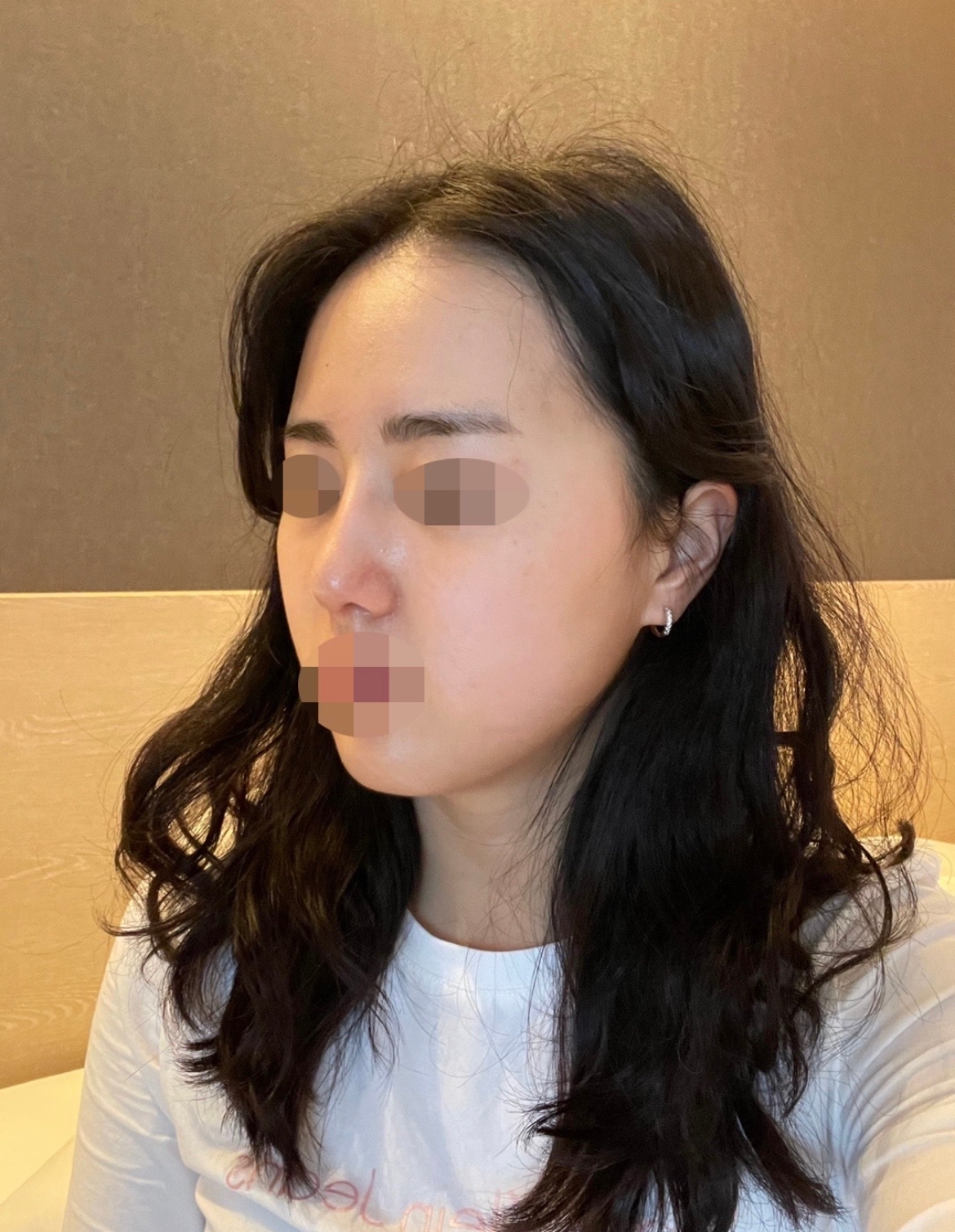 수술후기이미지