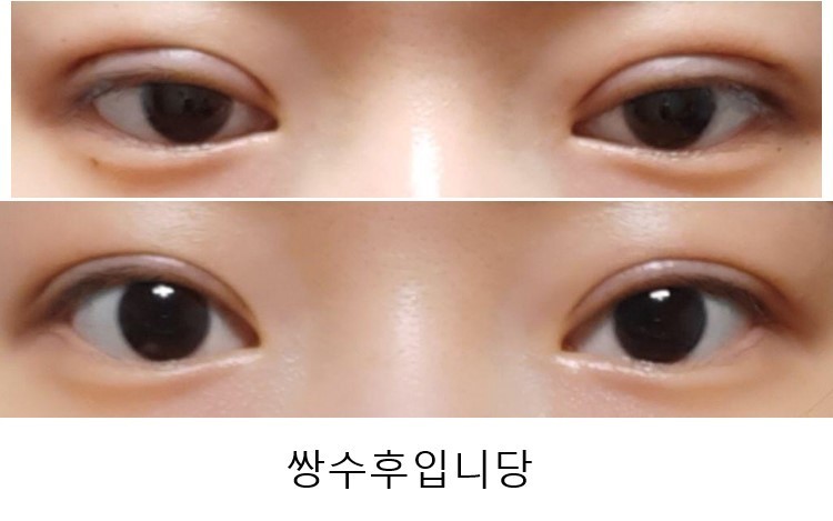 수술후기이미지