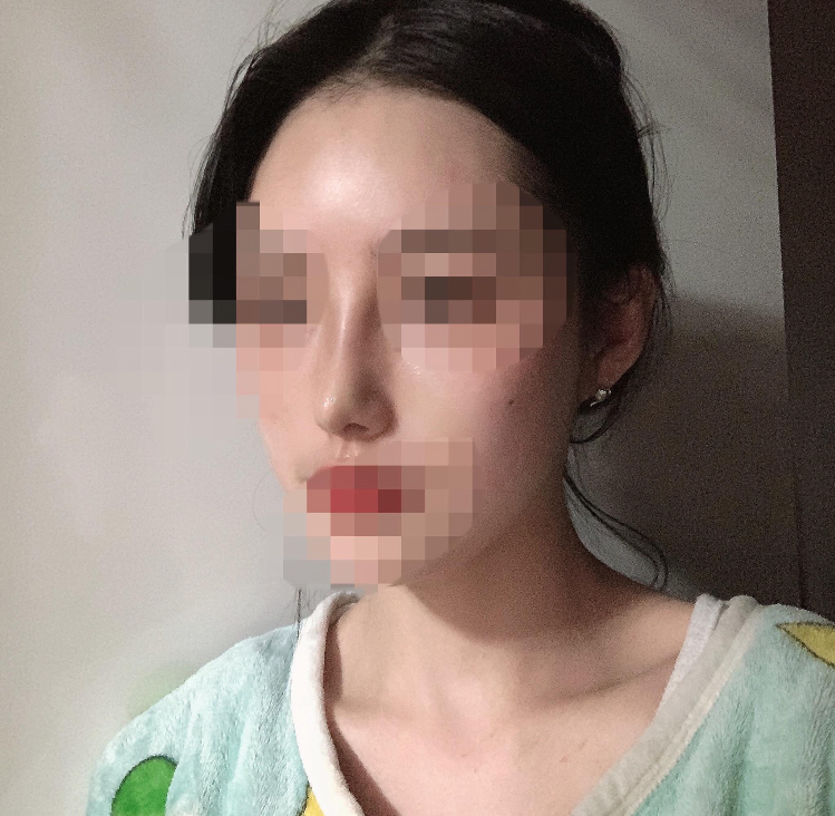 수술후기이미지