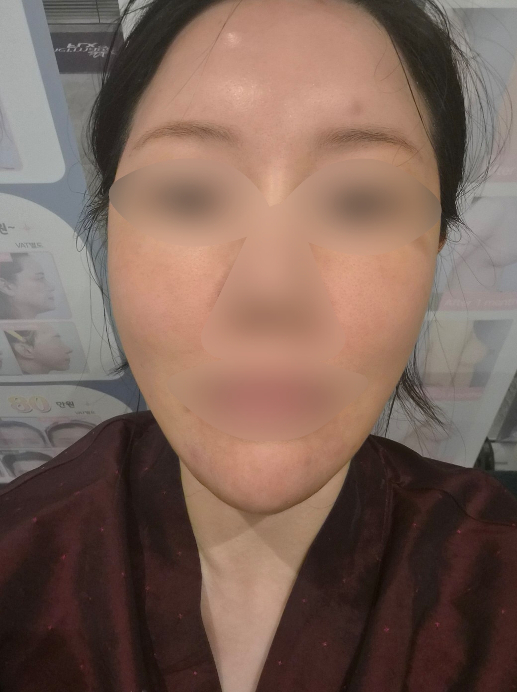 수술후기이미지