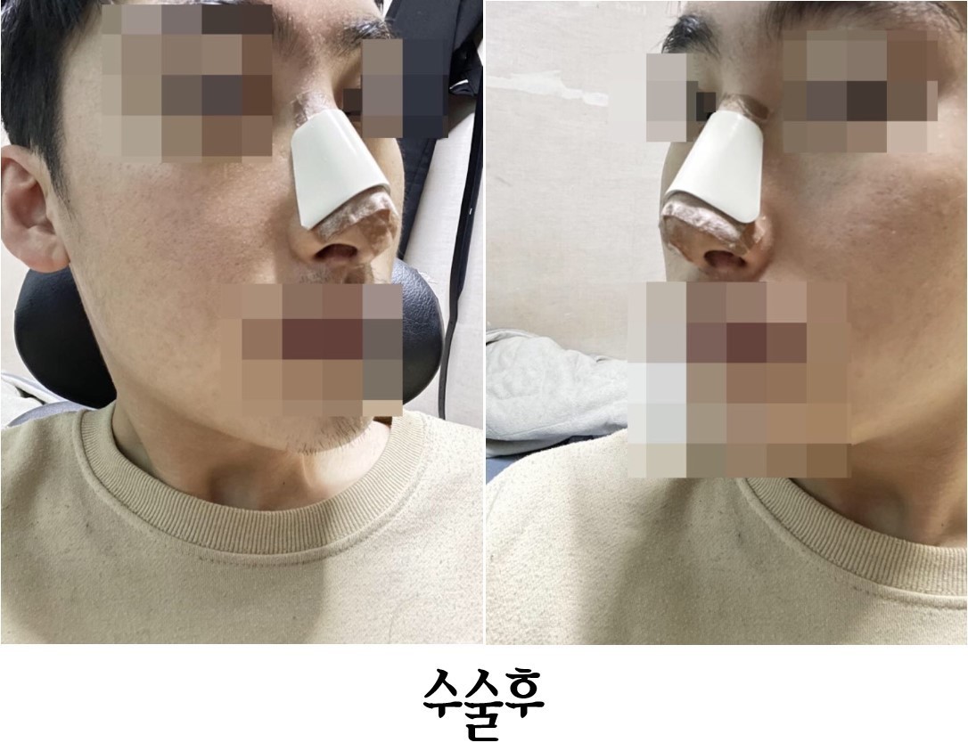 수술후기이미지