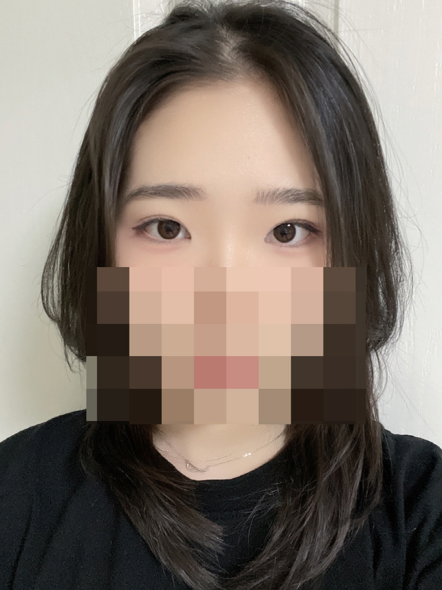 수술후기이미지