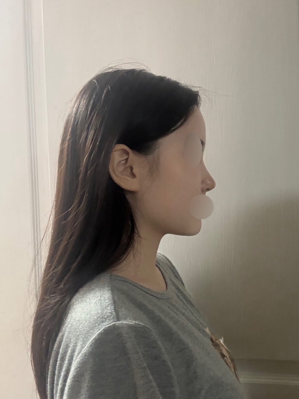 수술후기이미지