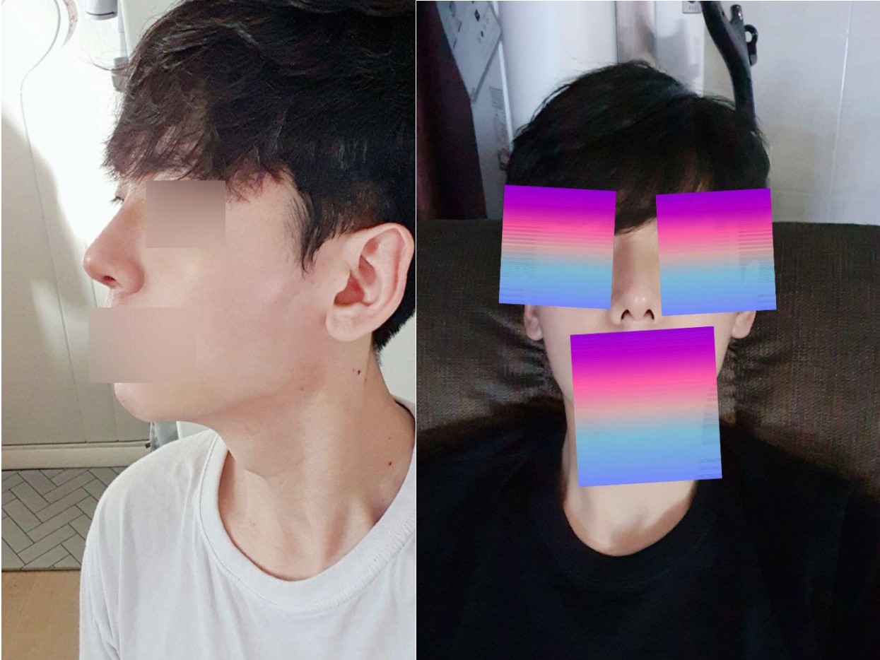 수술후기이미지