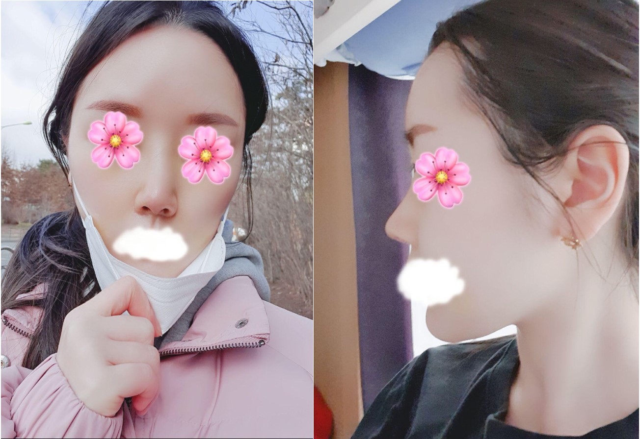 수술후기이미지