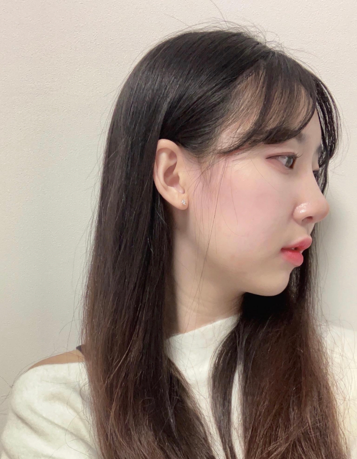 수술후기이미지