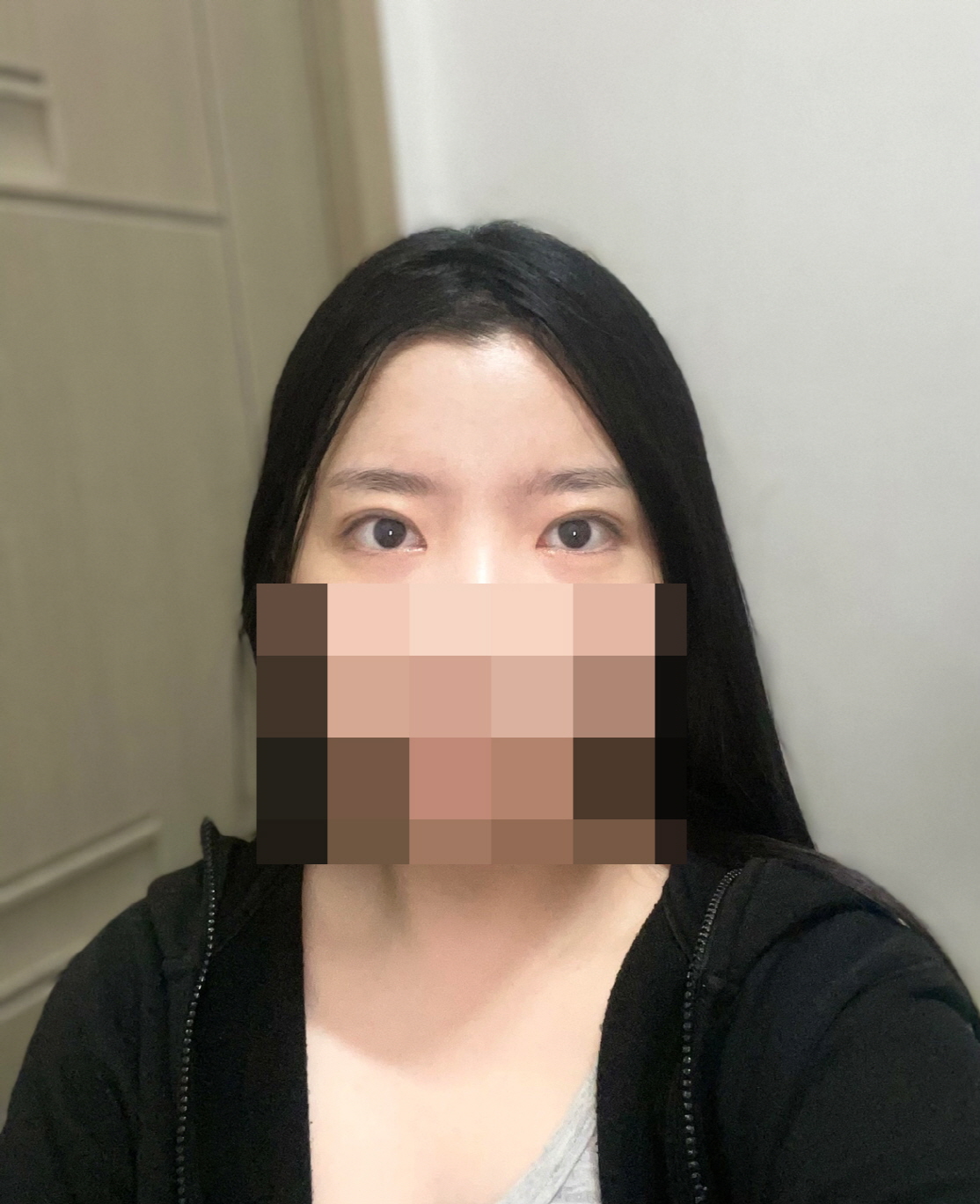 수술후기이미지