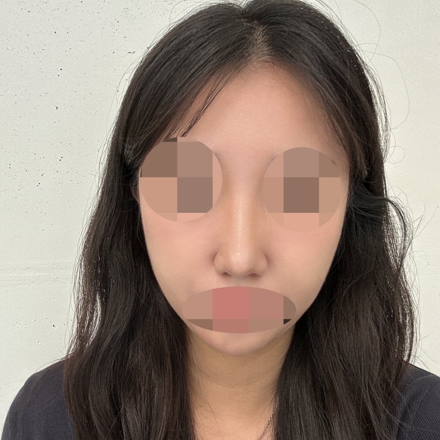 수술후기이미지