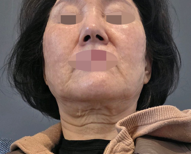 수술후기이미지