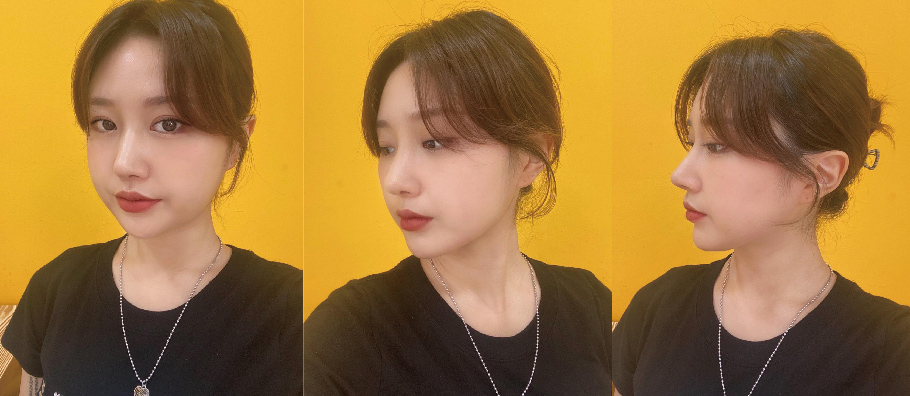 수술후기이미지