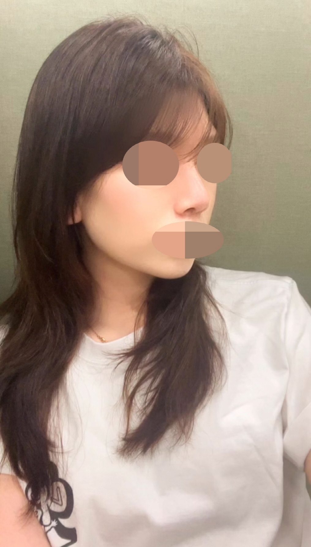 수술후기이미지