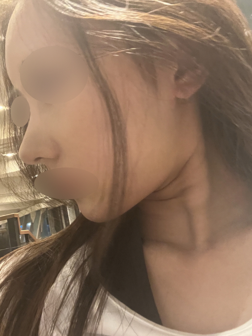 수술후기이미지