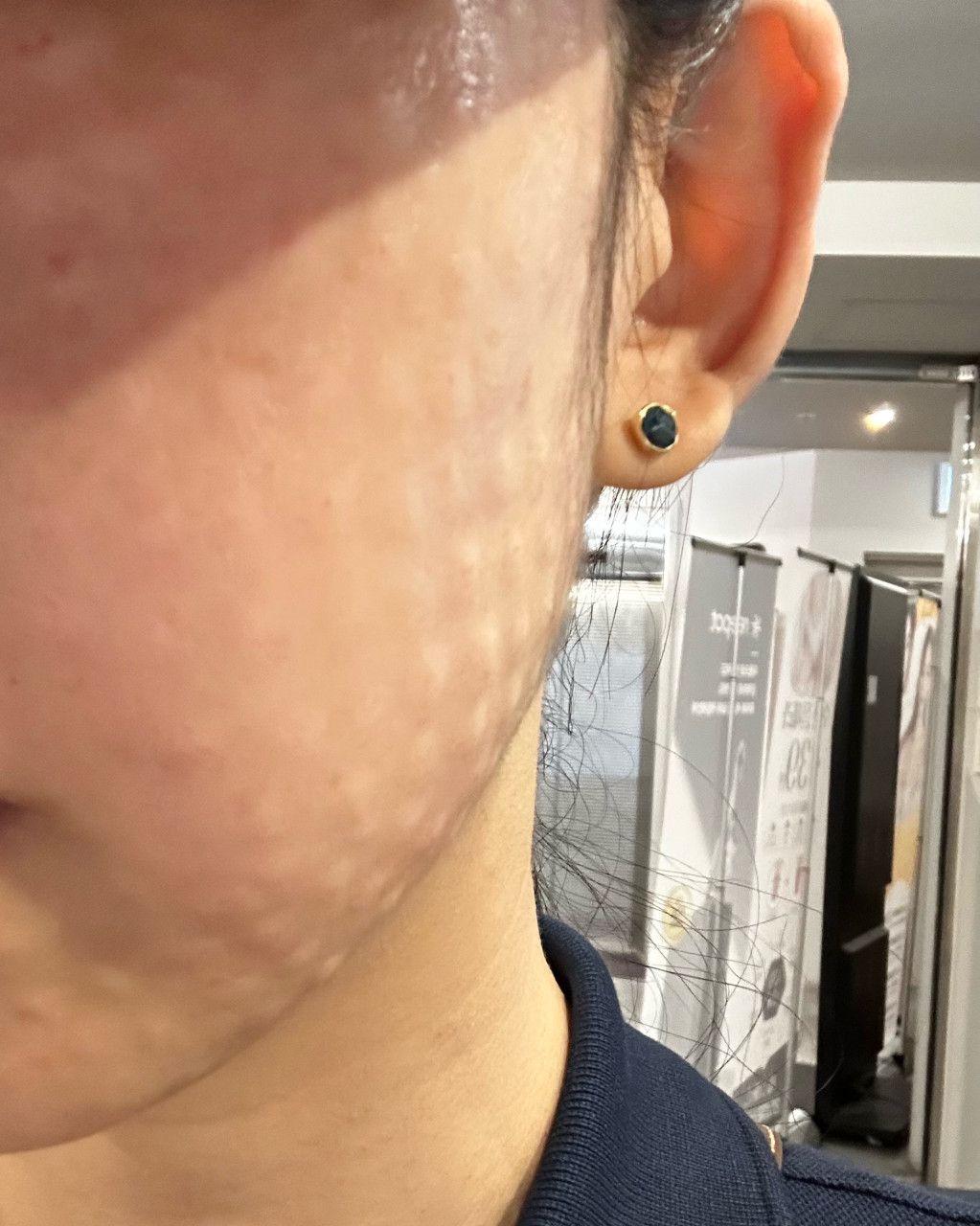 수술후기이미지