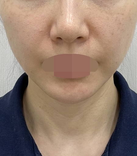 수술후기이미지