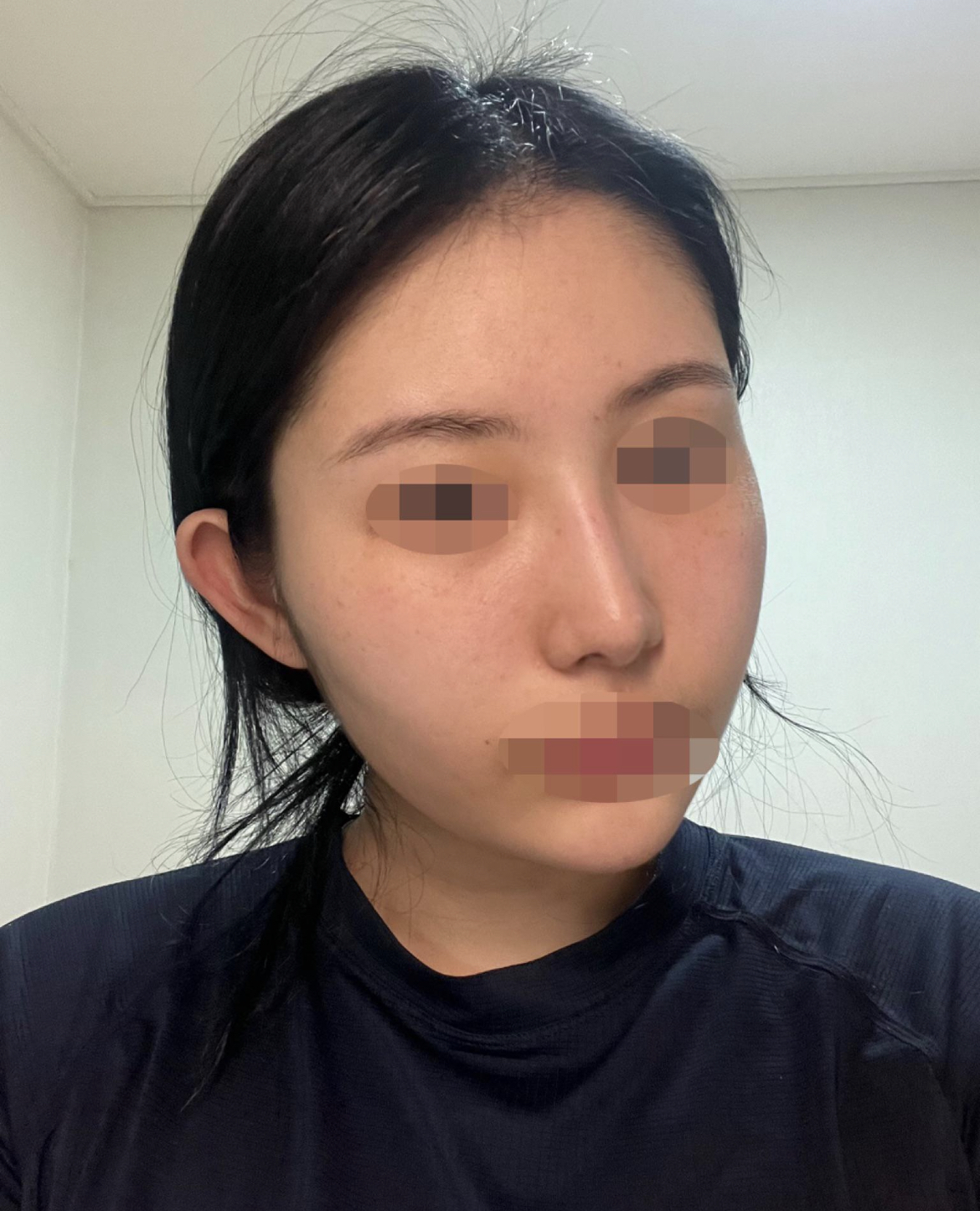 수술후기이미지