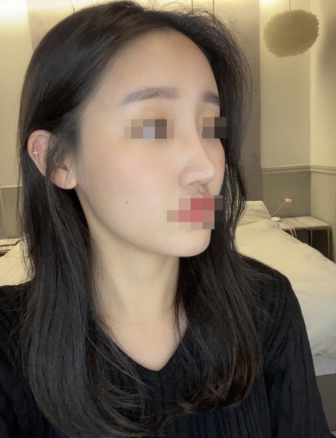 수술후기이미지