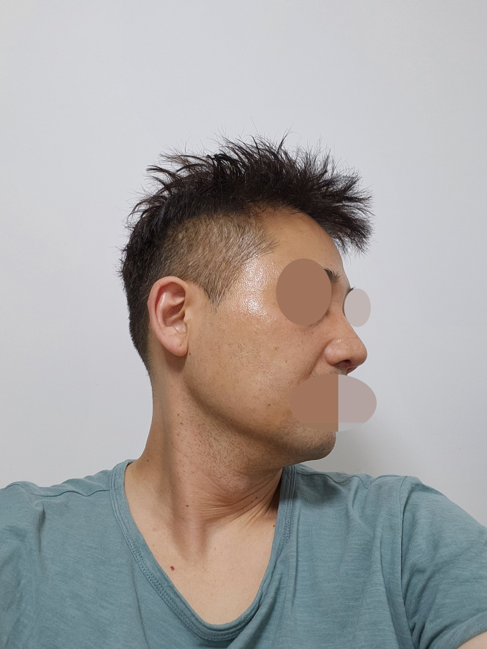 수술후기이미지