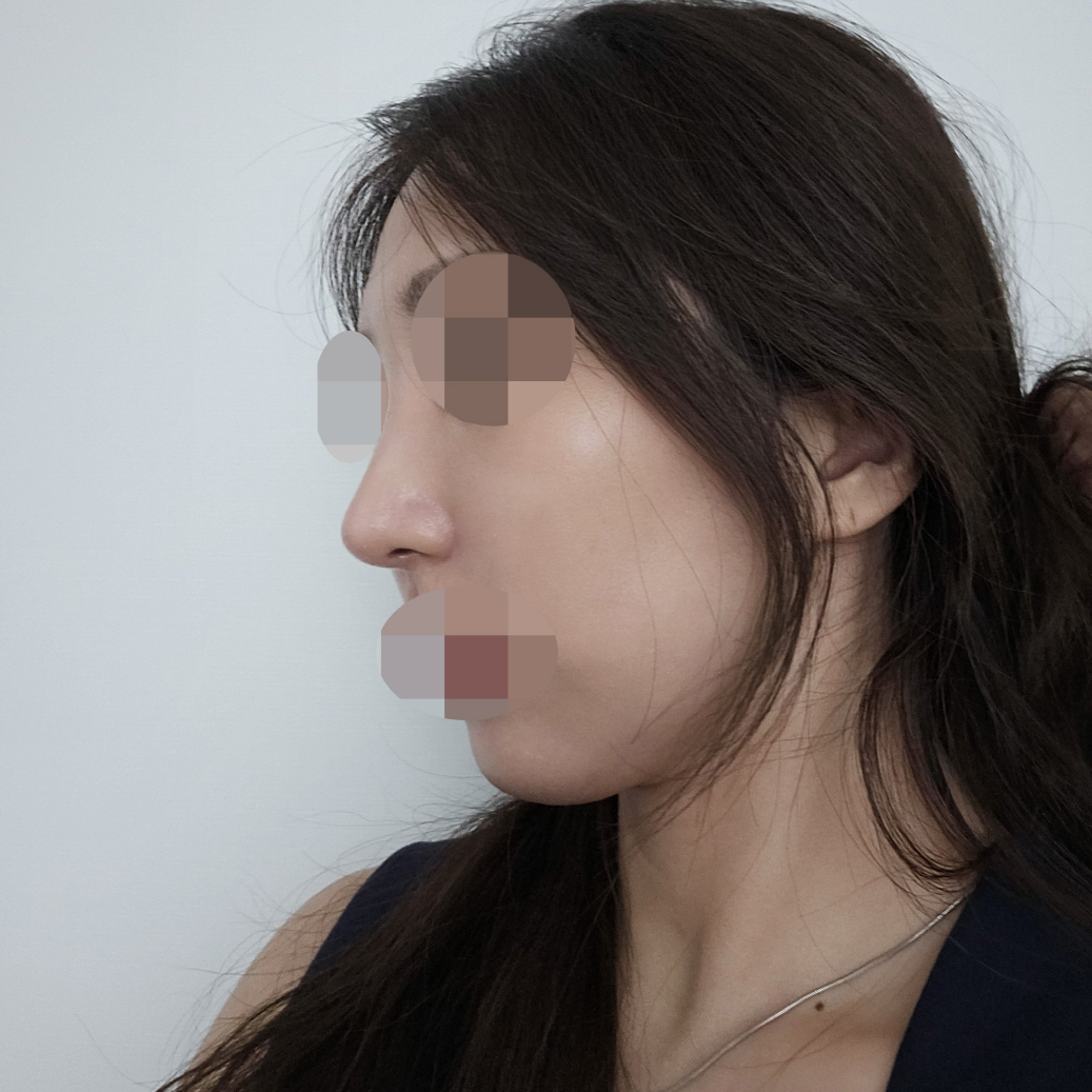 수술후기이미지