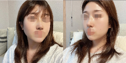 수술후기이미지