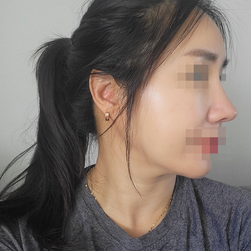 수술후기이미지