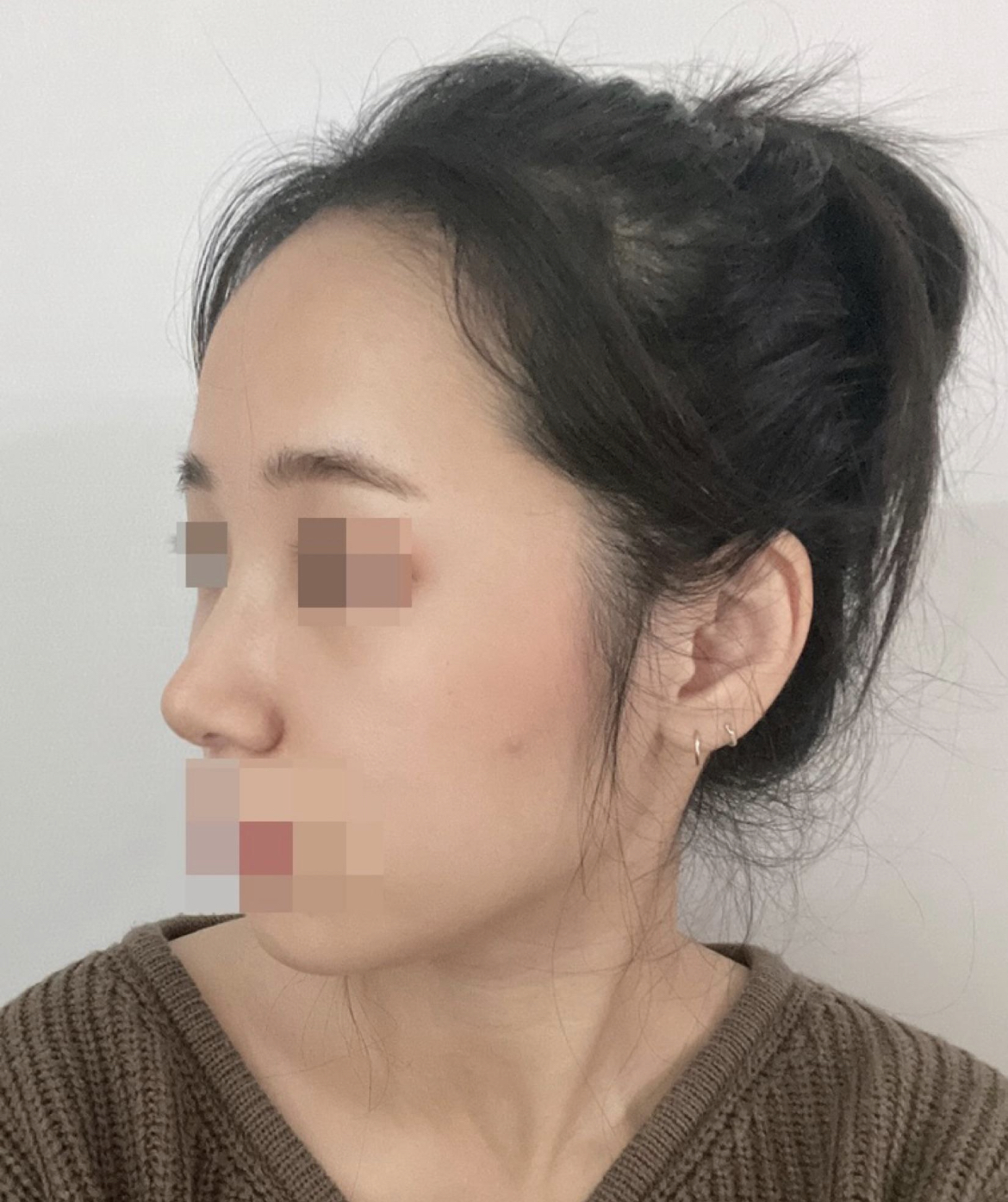 수술후기이미지