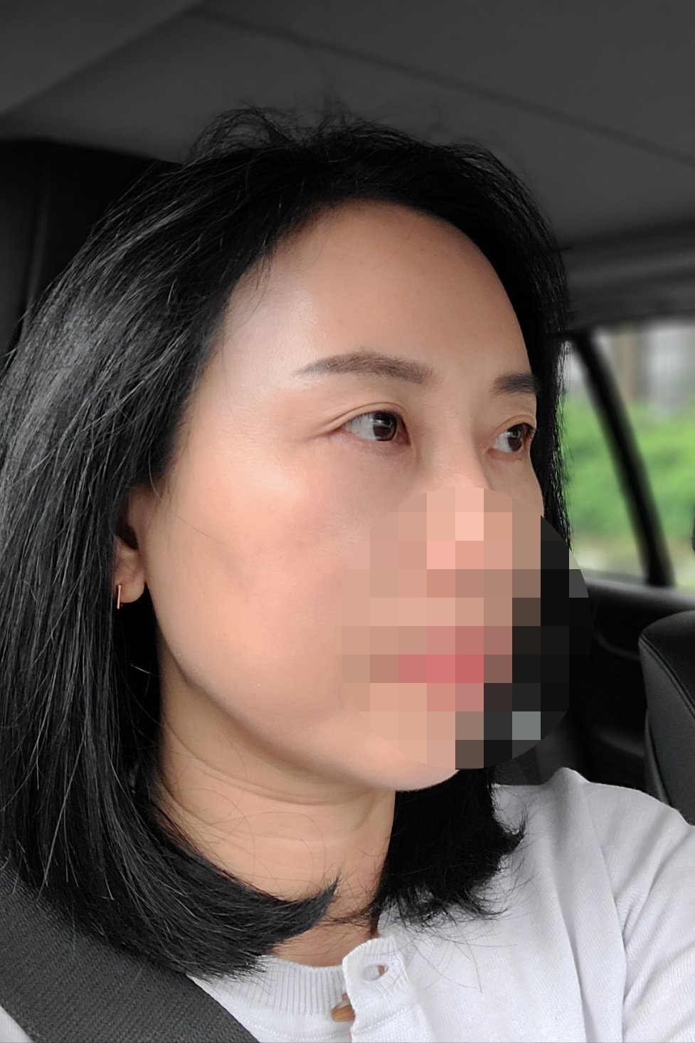 수술후기이미지