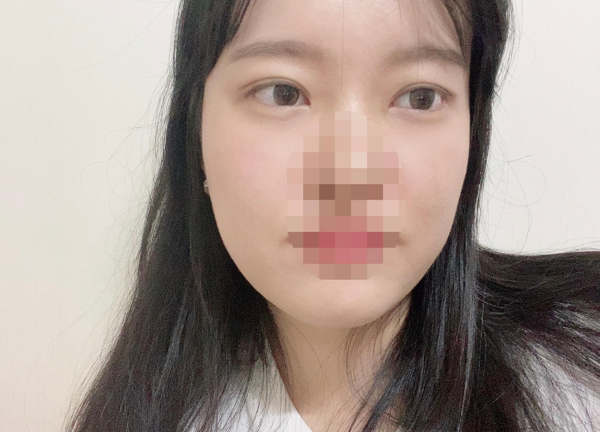 수술후기이미지