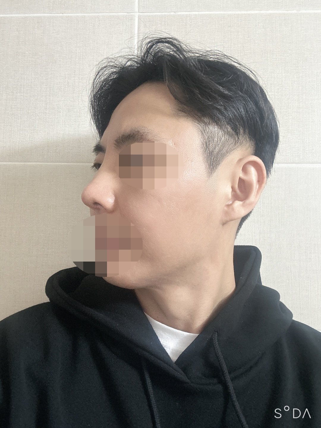 수술후기이미지