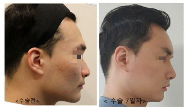 수술후기이미지