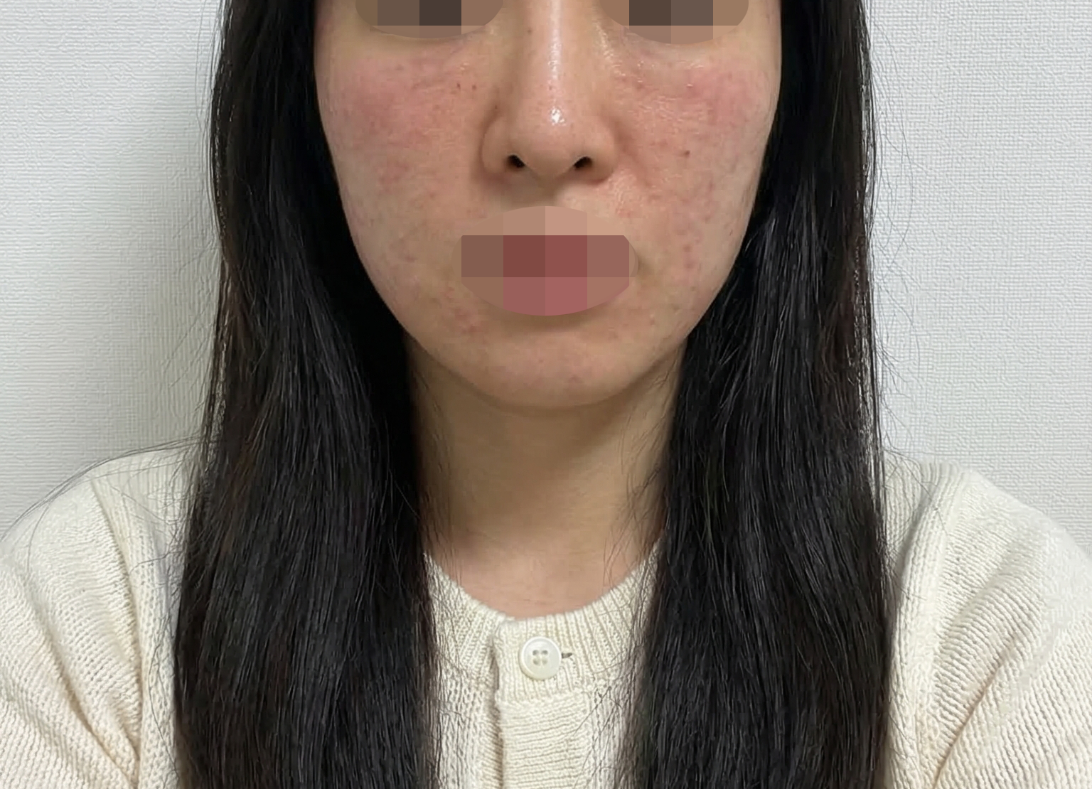 수술후기이미지