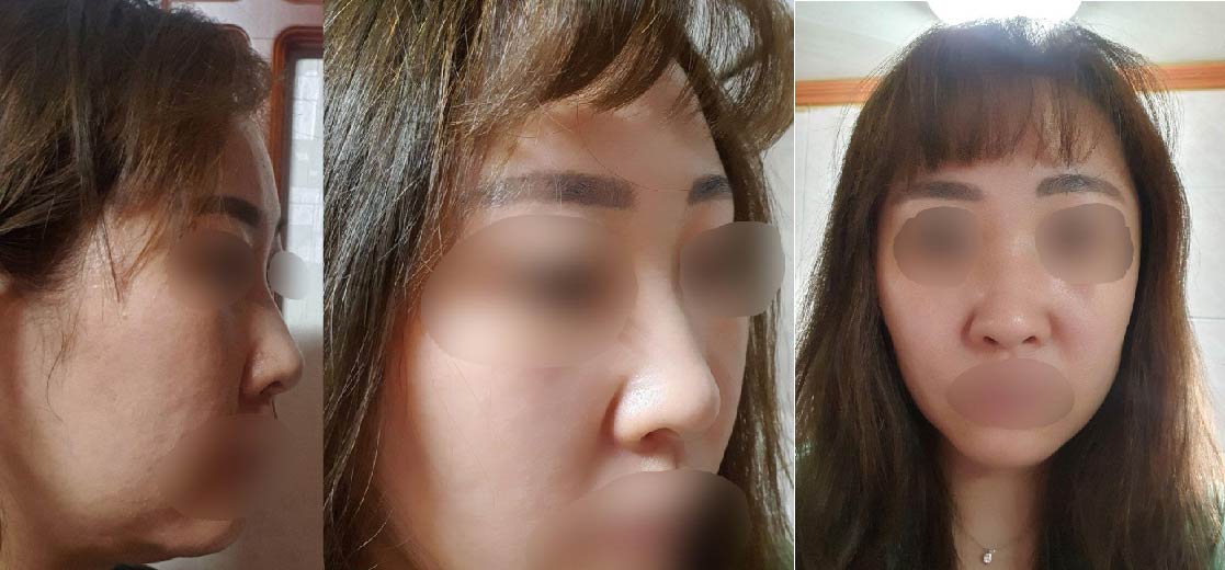 수술후기이미지