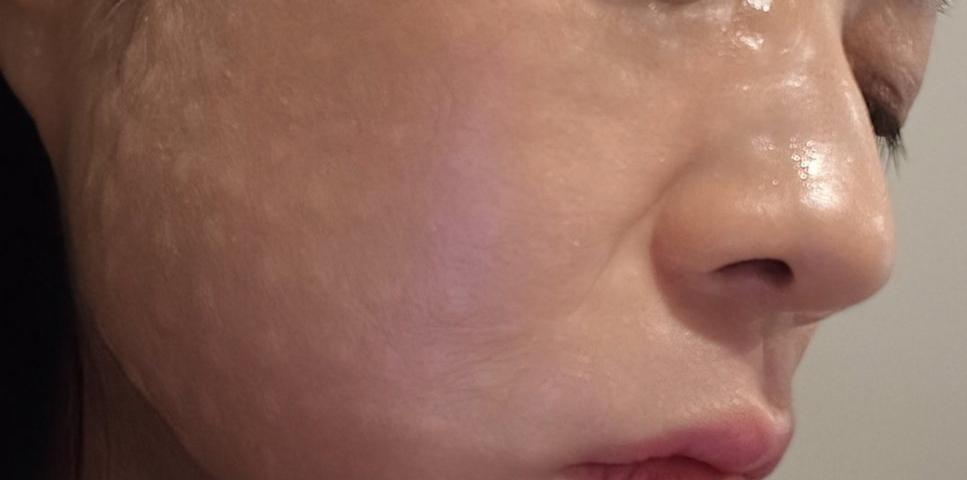 수술후기이미지