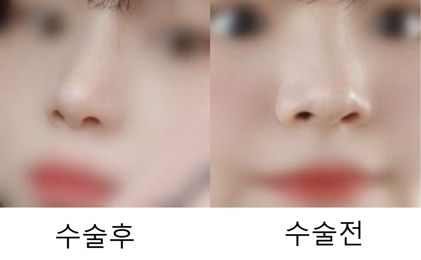 수술후기이미지