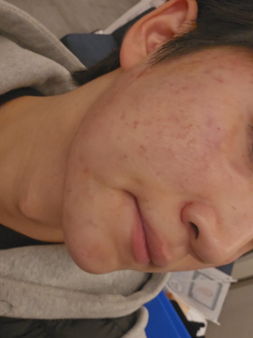 수술후기이미지