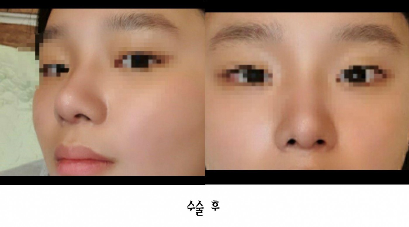 수술후기이미지