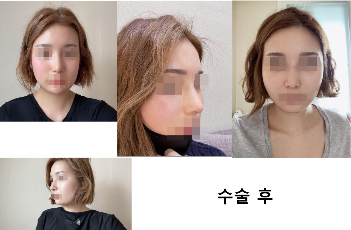 수술후기이미지