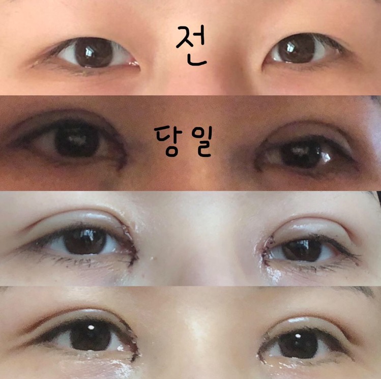 수술후기이미지