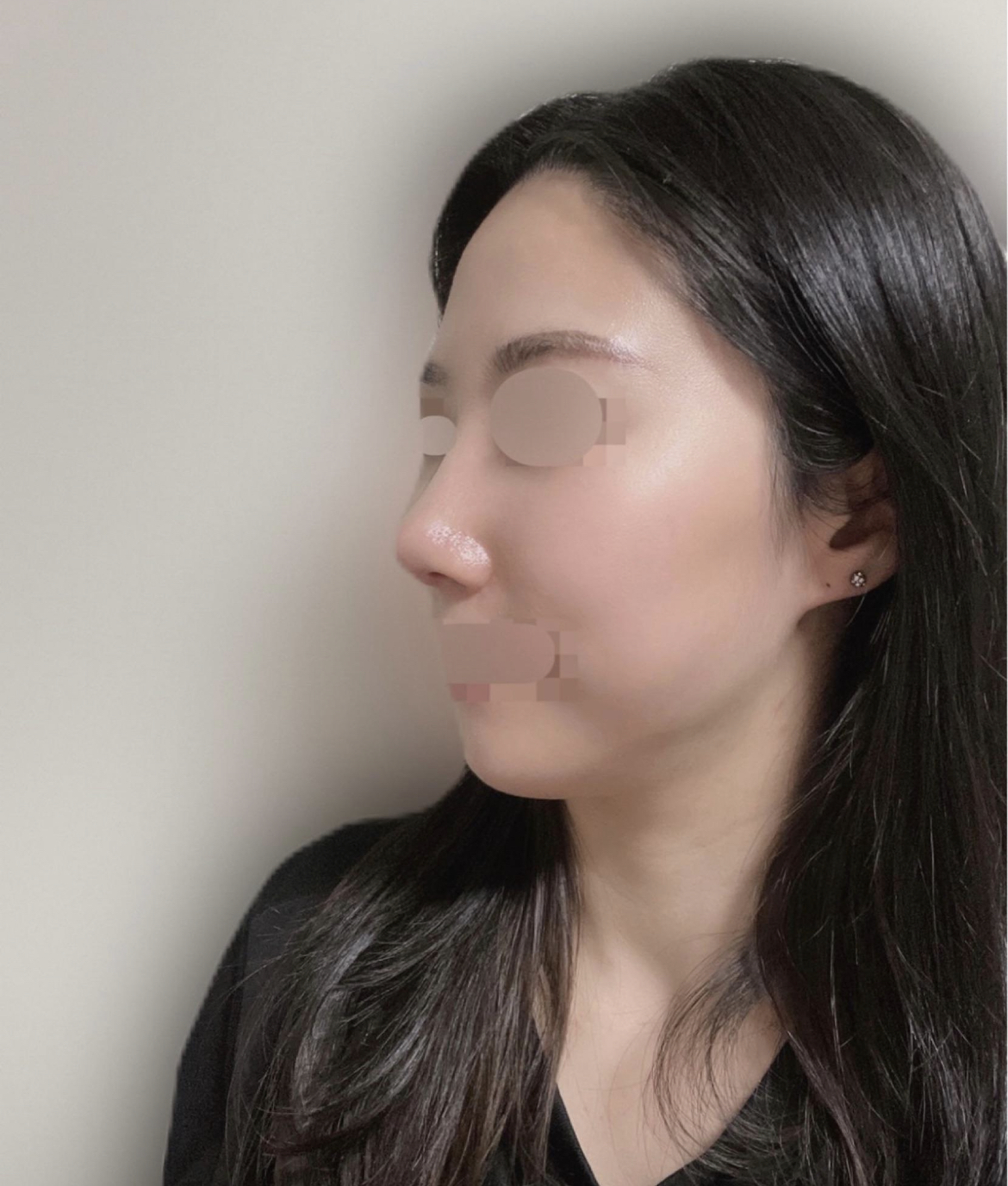 수술후기이미지