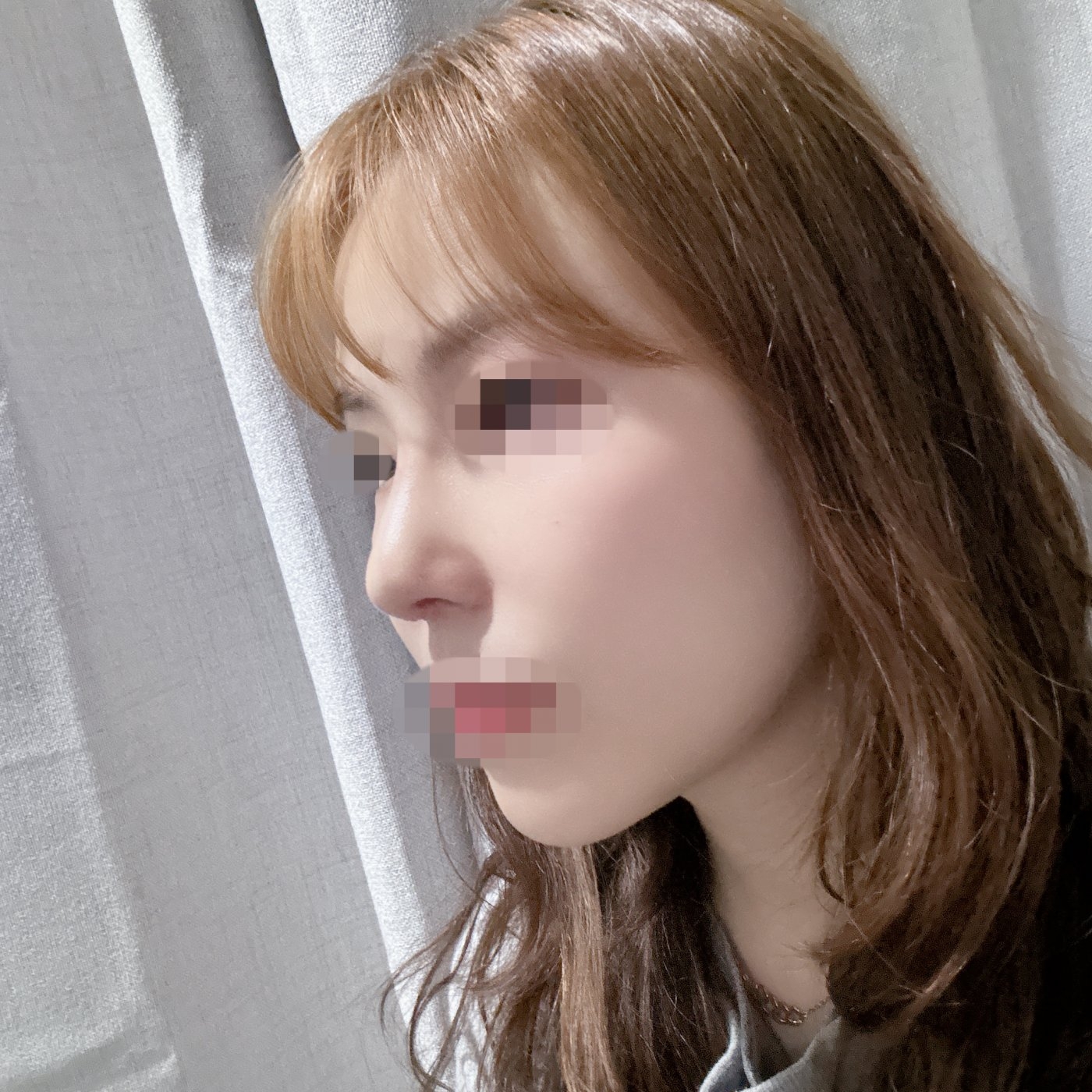 수술후기이미지