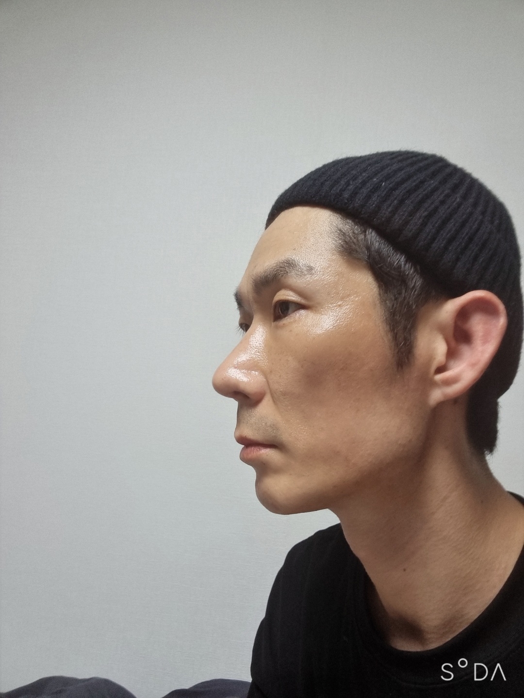 수술후기이미지