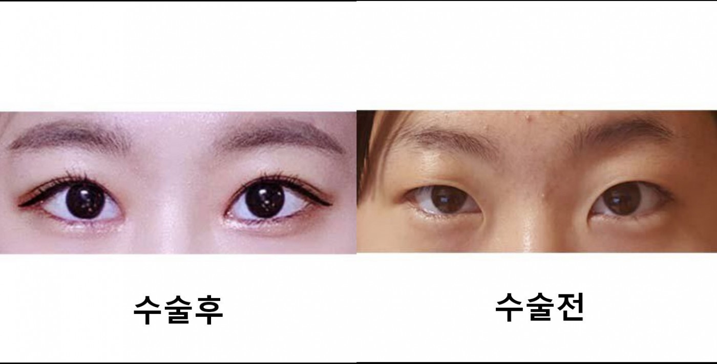 수술후기이미지