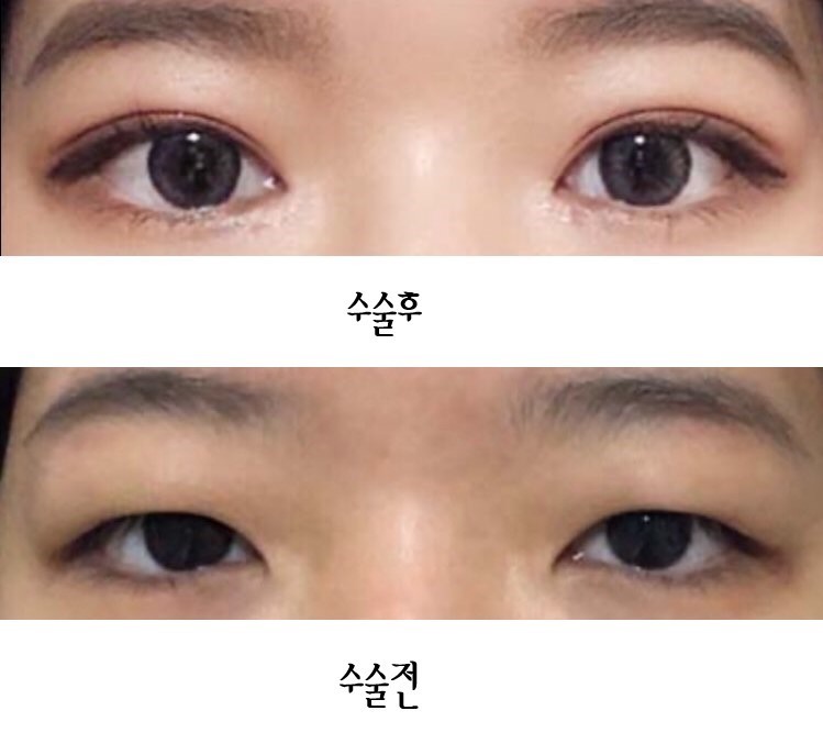 수술후기이미지