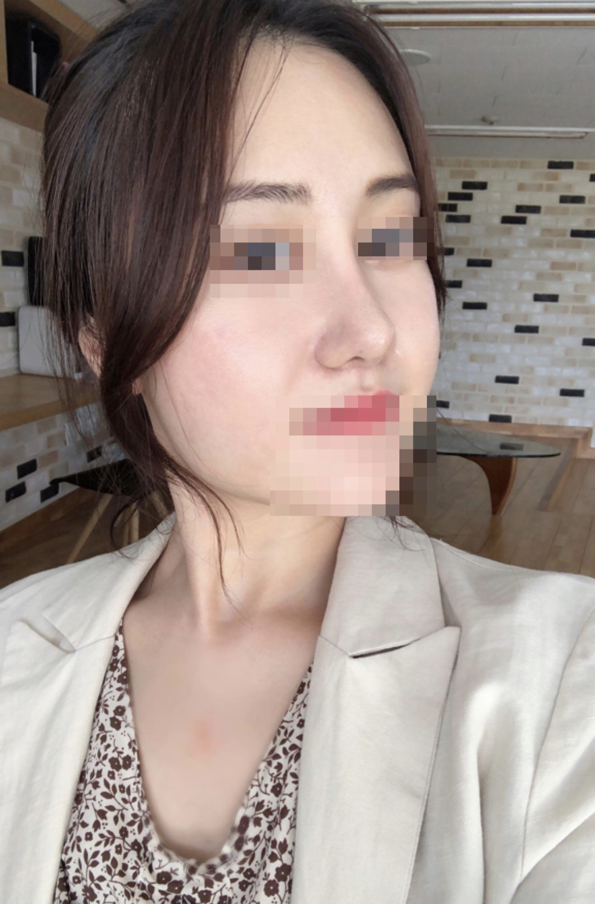 수술후기이미지