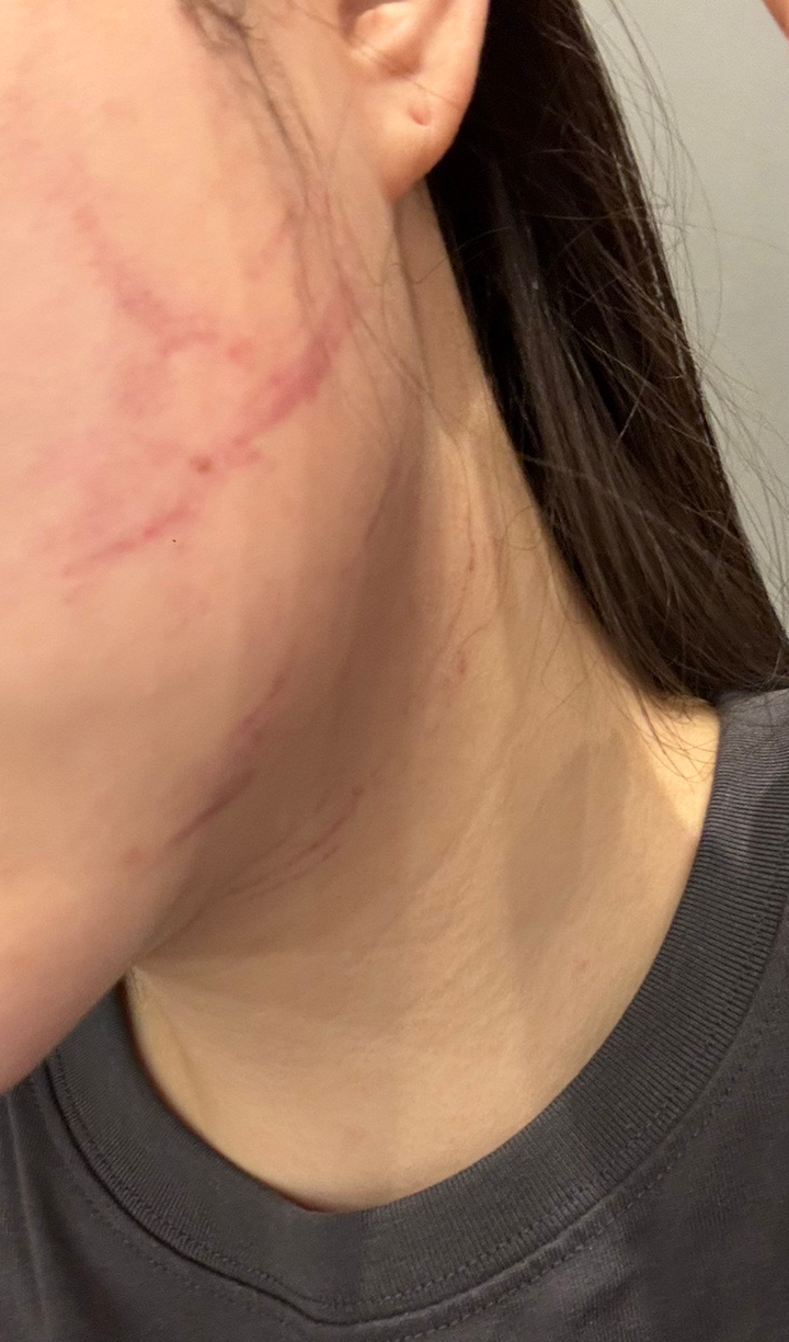 수술후기이미지